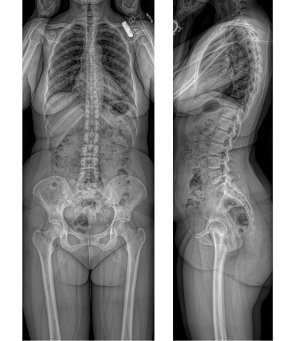A detailed medical scan produced by the EOS imaging machine, showcasing the skeletal structure of a female patient's body with high precision and clarity.