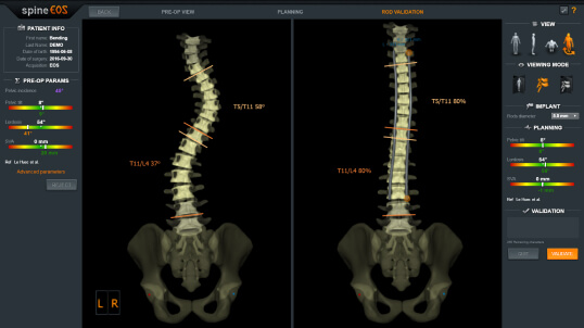 The EOS interface displaying a detailed scan of the spine, highlighting the curvature and structure of the vertebrae. This image provides diagnostic information for spinal conditions with precision.
